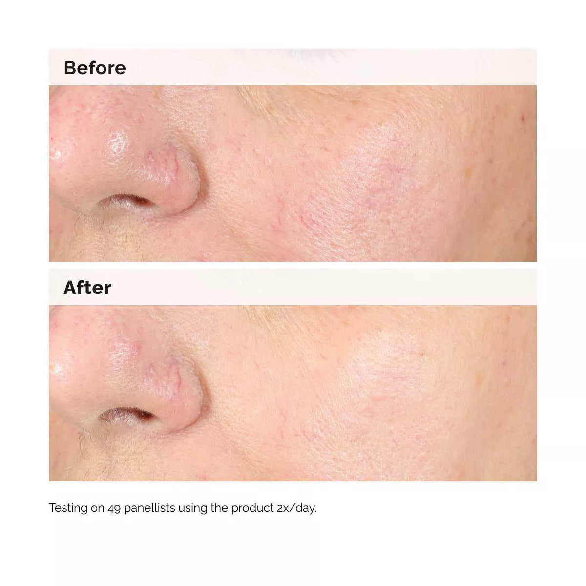 The Ordinary Alpha Arbutin 2% + Hyaluronic Acid for Hyperpigmentation - 1 Fl Oz - Ulta Beauty